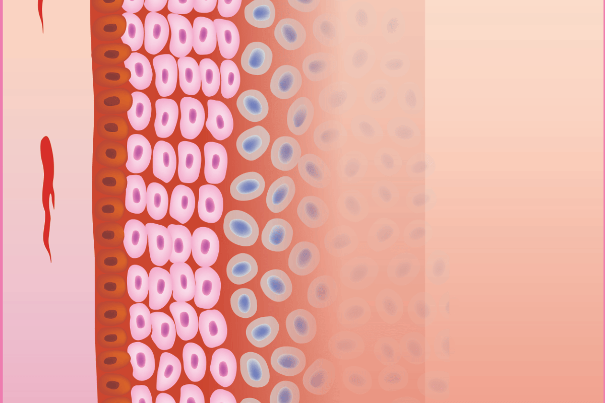 Illustration of postmenopausal vaginal tissue with a thinner epithelium, reduced blood supply and less moisture